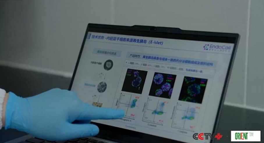 Китайские ученые проводят трансплантацию островковых клеток, полученных из стволовых клеток, для лечения диабета 1 типа